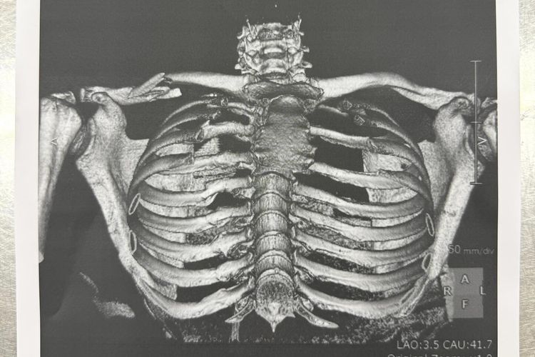 MotoGP, Aprilia, Sirkuit motegi, kecelakaan fatal, Jorge Martin, Massimo Rivola, motogp 2025, MotoGP Jepang 2025, Update Kondisi Jorge Martin, Patah Tulang Selangka